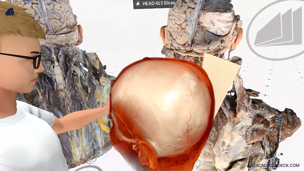 Brain aneurysms - the silent threat thumbnail 3